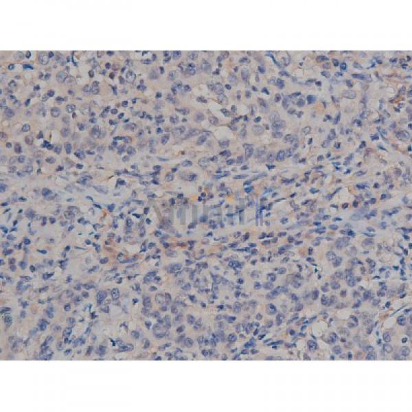 Phospho-Tau (Ser422)[Ser739] Antibody - AF3145 at 1/200 staining Human ganstric cancer tissue sections by IHC-P.